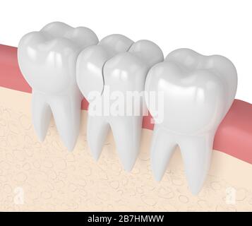 rappresentazione 3d delle gengive con dente trattabile fessurato su sfondo bianco. Diversi tipi di denti rotti concetto. Foto Stock