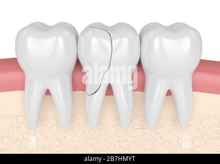 rappresentazione 3d delle gengive con dente trattabile fessurato su sfondo bianco. Cuspidi fratturate. Diversi tipi di denti rotti concetto. Foto Stock