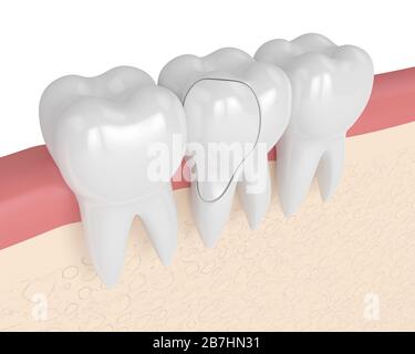 rappresentazione 3d delle gengive con dente trattabile fessurato su sfondo bianco. Cuspidi fratturate. Diversi tipi di denti rotti concetto. Foto Stock