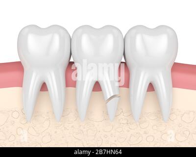 rendering 3d delle gengive con radice dentaria incrinata su sfondo bianco. Diversi tipi di denti rotti concetto. Foto Stock