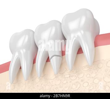 rendering 3d delle gengive con radice dentaria incrinata su sfondo bianco. Diversi tipi di denti rotti concetto. Foto Stock