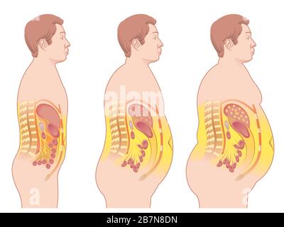 Illustrazione medica delle conseguenze dell'obesità. Foto Stock