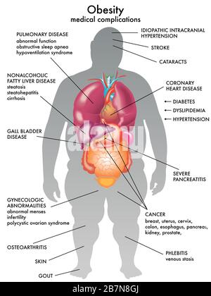 Illustrazione medica delle conseguenze dell'obesità. Foto Stock