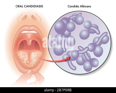 Illustrazione medica di un'infezione della lingua chiamata candidiasi orale. Foto Stock