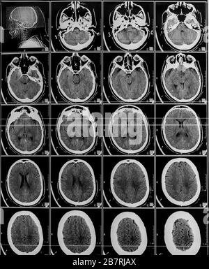 Tomografia elettromagnetica cervello. Sequenza di sezioni verticali di un cervello umano - scansione MRI. Diapositiva MRI cervello reale di una ragazza. Modifica minima da salvare Foto Stock