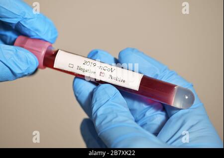 Coronavirus 2019-Ncov con analisi del sangue positiva Foto Stock