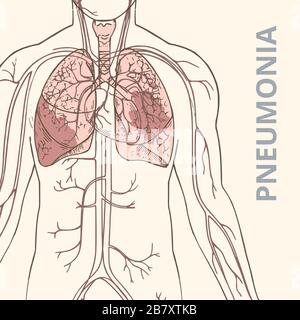 Un'illustrazione vettoriale schematica del corpo umano con organi interni e un'immagine della polmonite dei polmoni Illustrazione Vettoriale