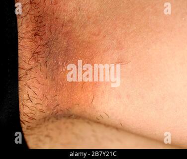 Infezione fungina nell'inguine, psoriasi, dermatite, eczema. Foto Stock