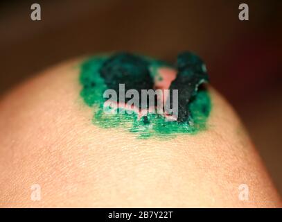 Ferita guaritrice sul ginocchio. La ferita trattata con verde brillante. La scab salirà Foto Stock