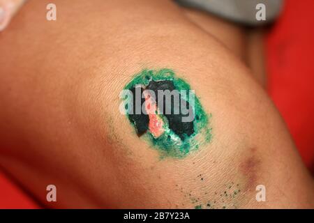 Ferita guaritrice sul ginocchio. La ferita trattata con verde brillante. La scab salirà Foto Stock