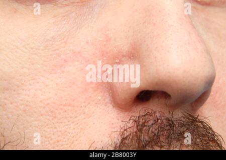 Parte del viso con il naso di un uomo bianco adulto con pelle secca e flaky. Problemi e malattie della pelle. Foto Stock