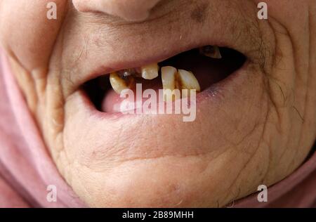donna anziana senza denti, donna anziana con pochi denti in bocca, Foto Stock