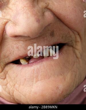donna anziana senza denti, donna anziana con pochi denti in bocca, Foto Stock