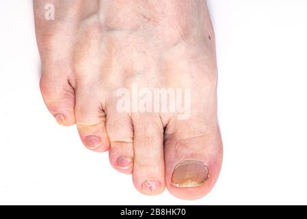 Primo piano toenail Fungus isolato su sfondo bianco, Nail Fungus sulle gambe dell'uomo Foto Stock