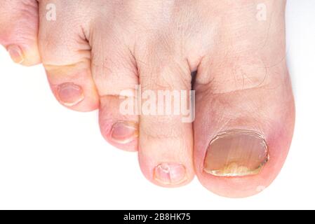 Primo piano toenail Fungus isolato su sfondo bianco, Nail Fungus sulle gambe dell'uomo Foto Stock