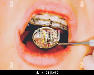Il dentista controlla le bretelle in una bocca del ragazzo giovane. Teen con le bretelle sui denti. Macro scatto di denti con bretelle Foto Stock