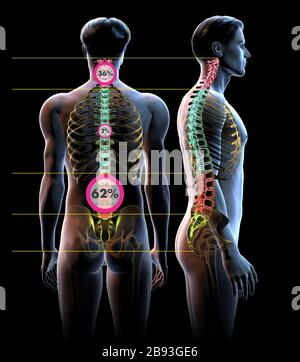 Illustrazione 3D che mostra una colonna vertebrale dolorosa, una vista posteriore e una vista laterale. Foto Stock