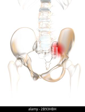 Colonna vertebrale umana con pelvi e articolazione sacroiliaca dolorosa Foto Stock