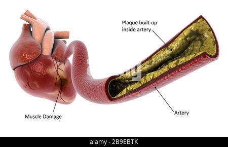 Illustrazione medica dell'accumulo di placca nell'arteria, che porta ad un attacco cardiaco. Foto Stock