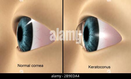 Illustrazione medica che mostra cheratocono nell'occhio. Foto Stock