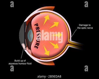 Illustrazione medica che mostra l'aumento della pressione nel bulbo oculare, che porta al glaucoma. Foto Stock