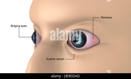 Illustrazione medica di esoftalmos, rigonfiamento degli occhi. Foto Stock