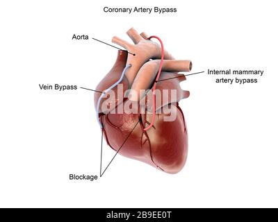 Bypass dell'arteria coronaria del cuore umano. Foto Stock