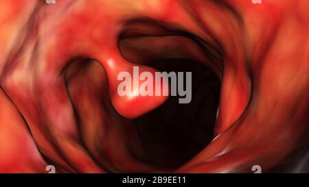 Primo piano illustrativo di un polipo del colon. Foto Stock