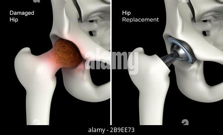 Illustrazione medica che mostra la sostituzione dell'anca di un'anca danneggiata. Foto Stock