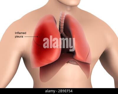 Illustrazione medica che mostra la pleurite nei polmoni umani. Foto Stock