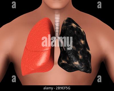 Confronto tra un polmone sano e un polmone fumatore. Foto Stock