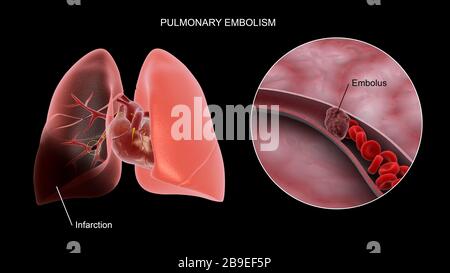 Concetto medico che mostra embolia polmonare nei polmoni umani. Foto Stock