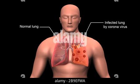 COVID-19 coronavirus infettante i polmoni umani, con etichette. Foto Stock