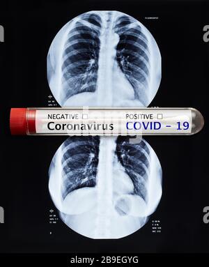 Tubo per analisi del sangue di coronavirus e immagine radiografica del torace umano per una diagnosi medica. Cosid-19 pandemie Foto Stock