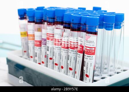 Diversi campioni di sangue infetti fittizi con vari virus su un rack per fiale. Foto Stock