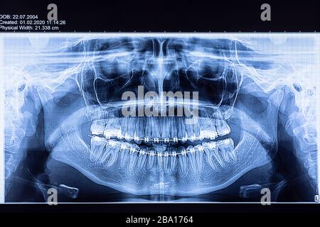 Radiografia dentale con staffe. Radiografia per la raddrizzatura dei denti e la ricerca di strutture dentali. Foto Stock