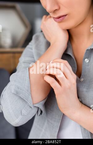 vista tagliata della donna allergica che graffia la mano Foto Stock