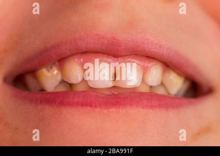 Bambino paziente bocca aperta che mostra cavità denti decadimento. Primo piano dei denti del bambino non sani. Medicina dentale e assistenza sanitaria - umana. Foto Stock