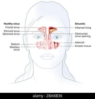 Illustrazione che mostra seno sano e sinusite con rivestimento infiammato, apertura del seno ostruita, adenoide e muco in eccesso Foto Stock