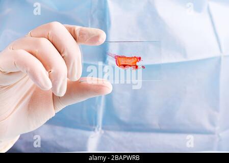 tecnico di laboratorio che gocciola sangue rosso umano sul vetrino per un test antivirus su sfondo blu Foto Stock