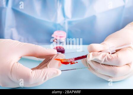 tecnico di laboratorio che gocciola sangue rosso umano sul vetrino per test di malaria su sfondo blu Foto Stock