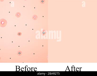 Texture, pimples infiammati e acne. Prima dopo acne. Sfondo della pelle. Infografica. Illustrazione vettoriale su sfondo isolato Illustrazione Vettoriale