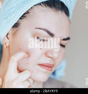 Bella ragazza con asciugamano sulla testa che stringe pimple in asciugamano sulla sua testa. Foto Stock