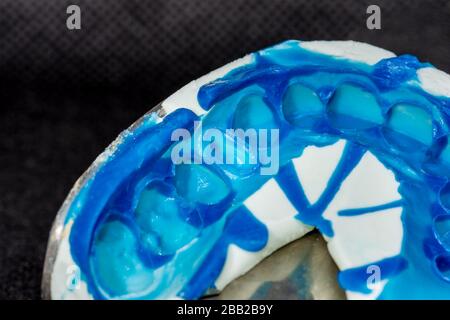 impronta in silicone di denti umani primo piano. produzione di corone dentarie e spine di radice. Foto Stock