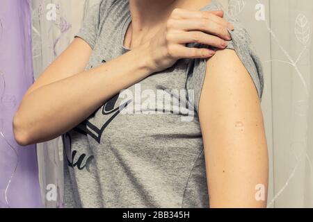 Donna con vaiolo in seguito alla vaccinazione con BCG contro il vaccino contro la tubercolosi sul suo braccio Foto Stock