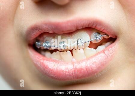 Primo piano sui denti con staffe ortodontiche. Cure dentistiche. Foto Stock