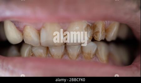 Denti con decorazioni ravvicinate. Ci sono macchie marroni sul dente. Foto Stock