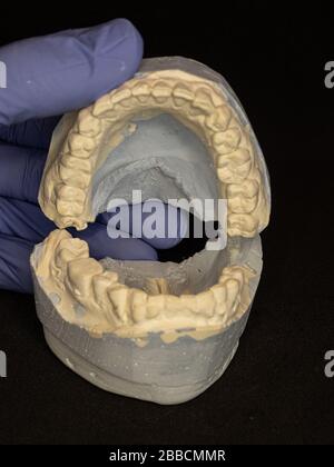 Modello di gesso dentale stampo di denti in gesso. Difetti delle ganasce con impatto sul consumo del paziente. Foto 1 da 5 Foto Stock