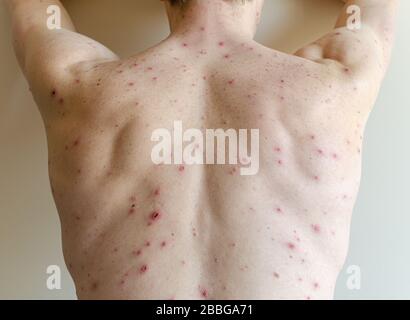 Grandi macchie e pimples acne sul corpo - corpo adulto con varicella. Uomo con Chickenpox, Varicella, virus varicella zoster. Foto Stock