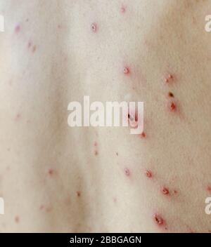 Grandi macchie e pimples acne sul corpo - corpo adulto con varicella. Uomo con Chickenpox, Varicella, virus varicella zoster. Foto Stock